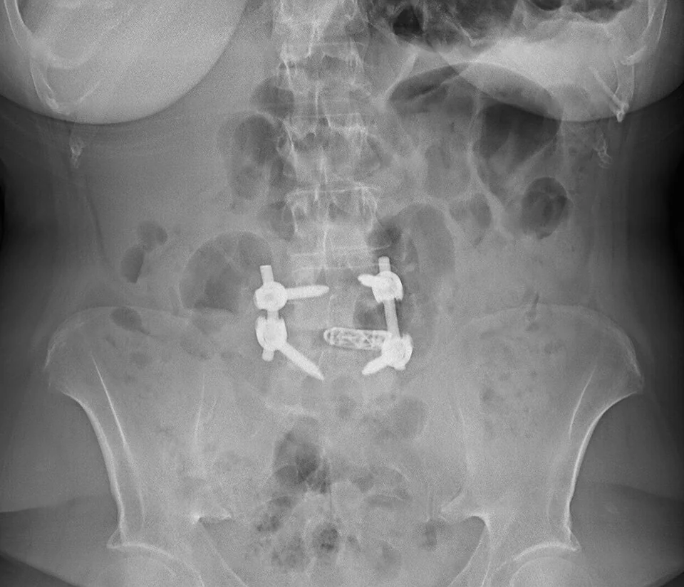Radiografia frontale del rachide lombare con quattro viti peduncolari, due barre e una cage intersomatica, interamente visibili